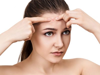 Acne Mark Treatment