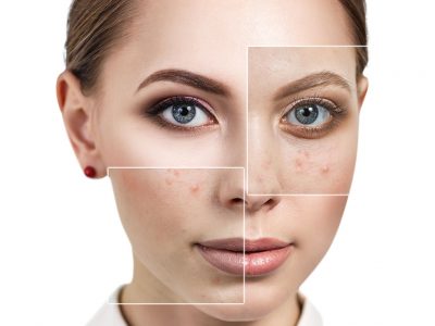 Dermabrasion device is used to remove spots on the skin surface.