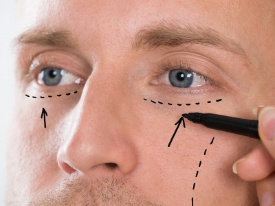  With eyelid aesthetics surgery, bagging and sagging of the lower eyelids are removed.