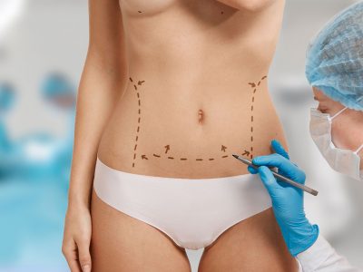 Abdominal sagging is removed with abdominal stretching surgery.