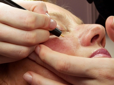 Laser capillary treatment to remove capillaries in the face area.