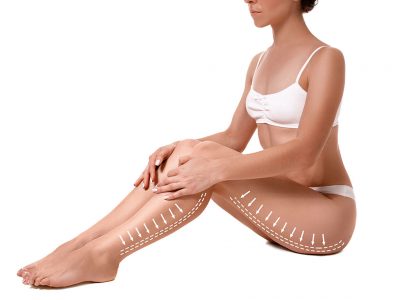 Laser liposuction is taken by melting the fats under the skin.