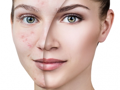 With acne treatment, acne spots are removed.