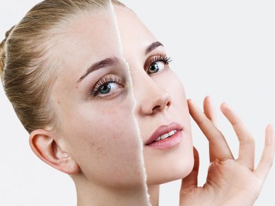 Blemish Treatment