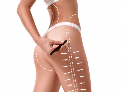 In the lipolysis process, fats are melted using laser.