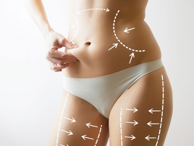 Liposuction