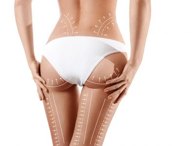 Liposacrine surgery is used to remove the fat under the skin.