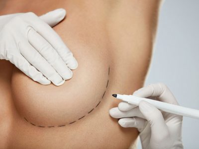 With the breast uplift surgery, sagging and loosening is achieved and a steeper chest is formed.