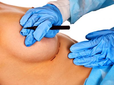 With breast reduction aesthetics, excess fat and skin in the breast tissue are removed.
