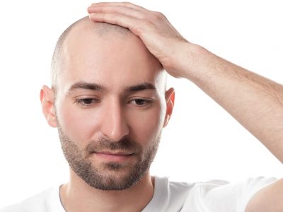 Hair Loss Treatment - Male Type Hair Loss, Prices - Ankara