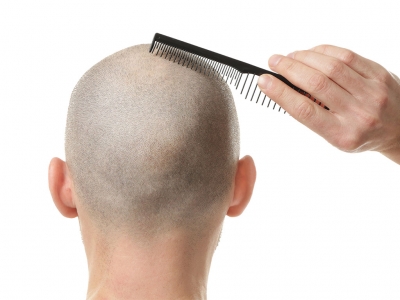 Hair loss treatments include prp and mesotherapy with hair transplantation.