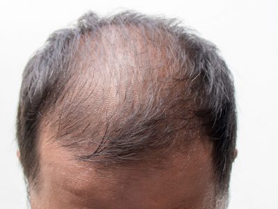 PRP and mesotherapy are used in hair loss treatment methods.