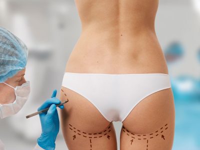  Fat removal surgery is taken from certain parts of the body.