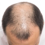 Saç Ekimi ile İlgili Merak Edilenler