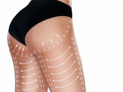 The upper leg is tightened with thigh-stretching surgery.