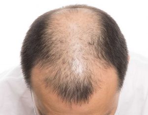 Saç Ekimi Hakkında Merak Edilenler